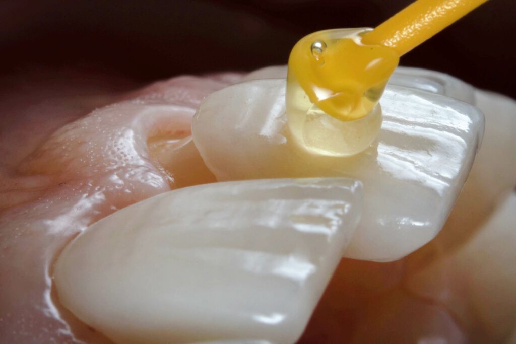 Closeup of veneers being cemented to front teeth