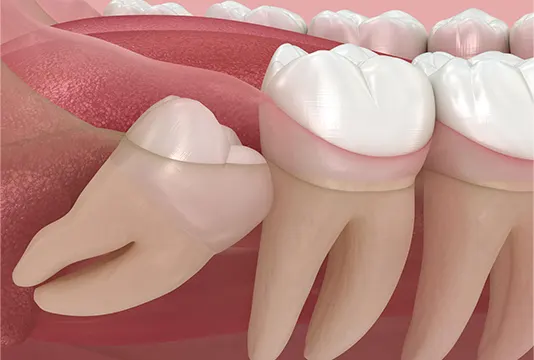 Signs You May Need Wisdom Tooth Removal