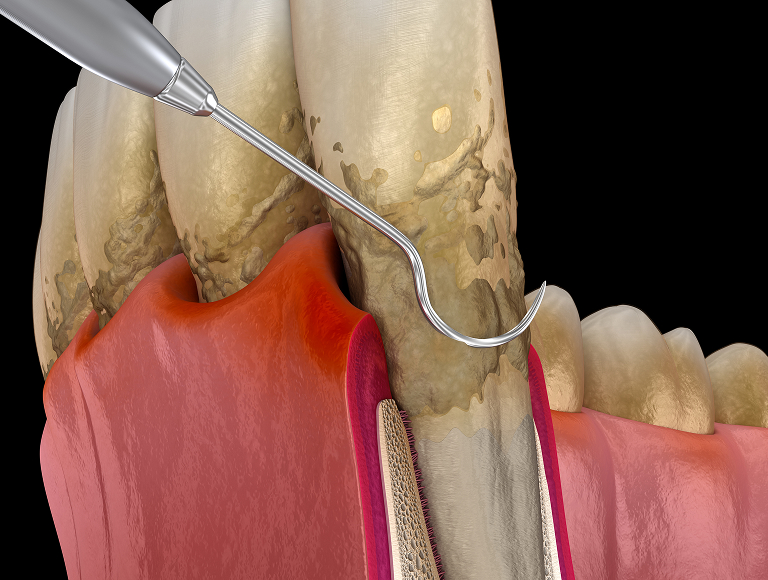 Periodontal Therapy