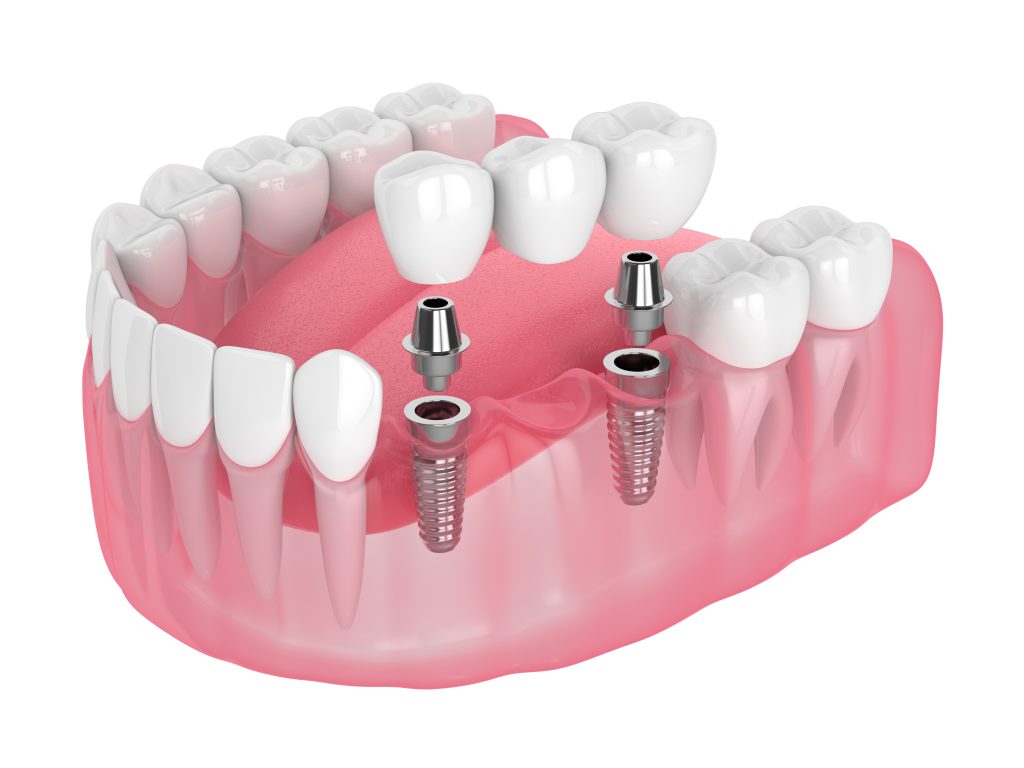 Missing Multiple Teeth