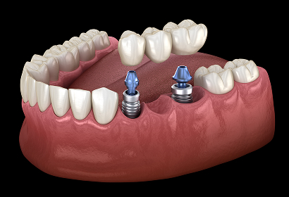 Implant-Supported Bridge