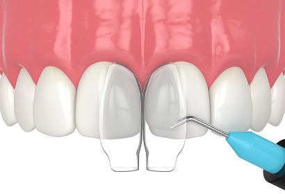 Cosmetic Bonding